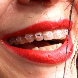 Orthodontic Treatment