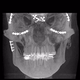 The OPEN REDUCTION Oral Surgery w/Dr. Tom Bolten