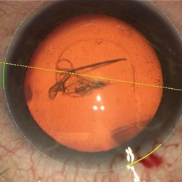 Advanced Ophthalmology Surgery